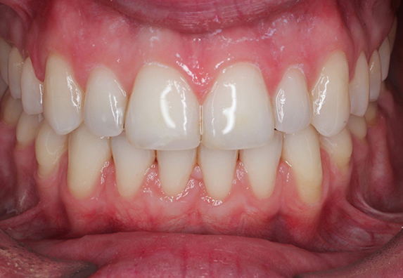 ortodoncia-adulto-before