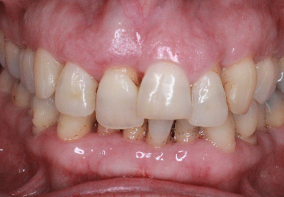 ortodoncia-invisible-adultos-before